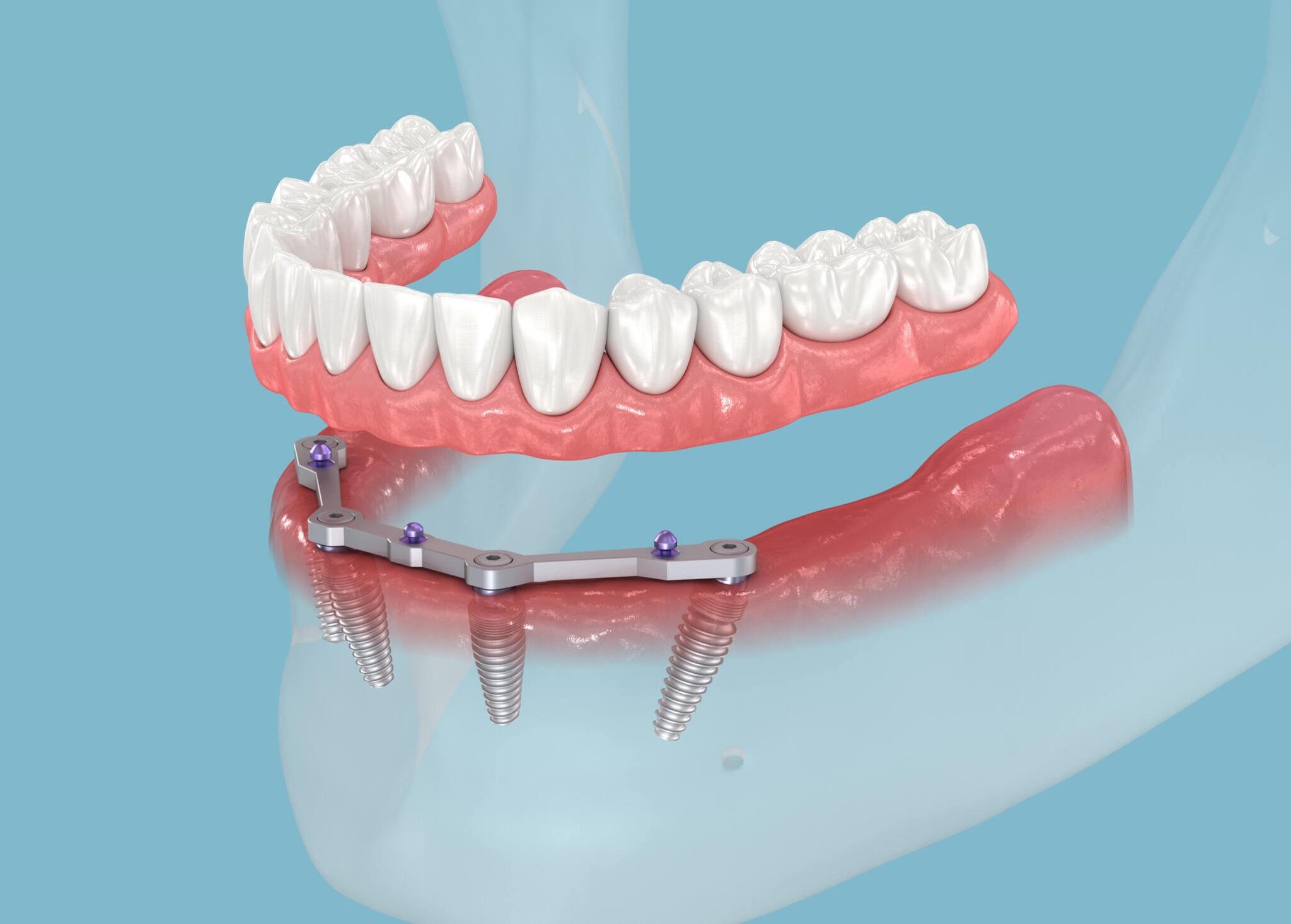 The Benefits of Dental Implants: Insights from Navan’s Top Practices