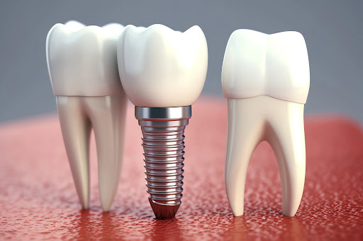 The Art of Smile Restoration with Dental Implants