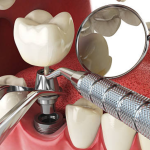 Achieving Longevity and Resilience with Dental Implants