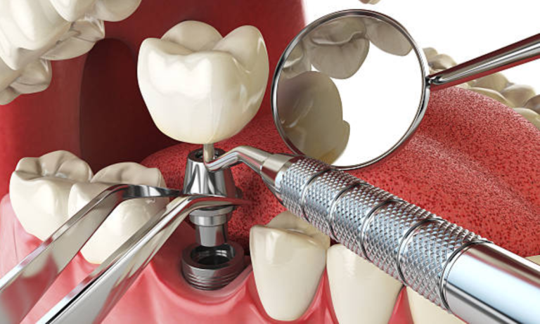 Achieving Longevity and Resilience with Dental Implants