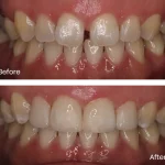 Exploring the Art of Natural Texture in Composite Bonding