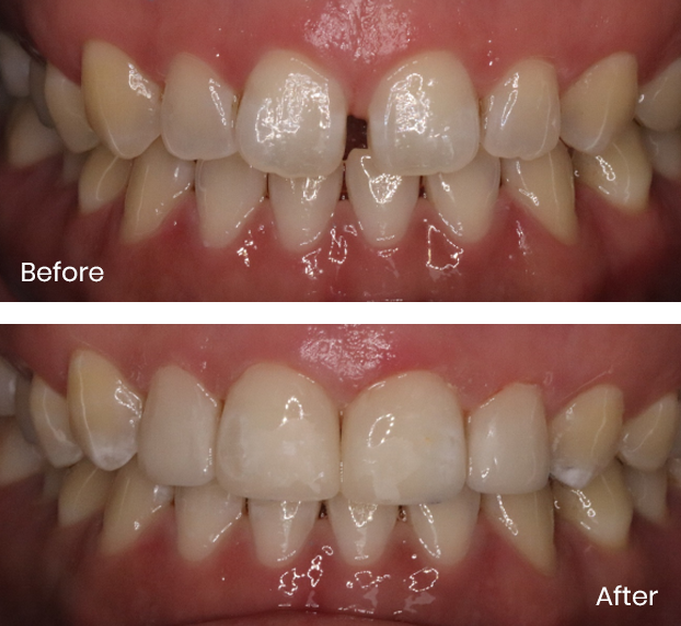 Exploring the Art of Natural Texture in Composite Bonding